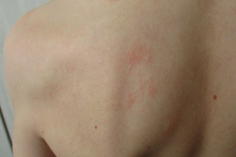 Rote und juckende Stellen am Rücken von Whirlpool Allergie